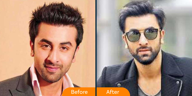 Ranbir Kapoor hair transplant 