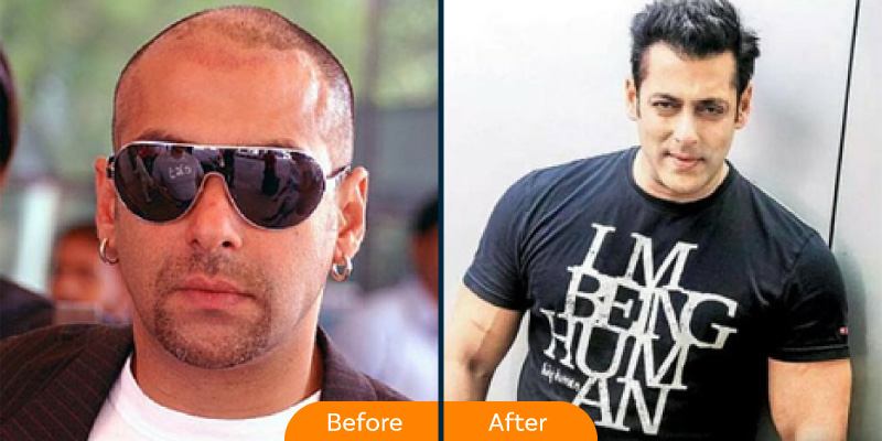 Salman Khan hair transplant 