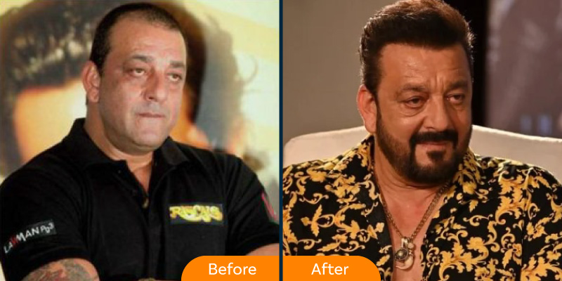 Sanjay Dutt hair transplant