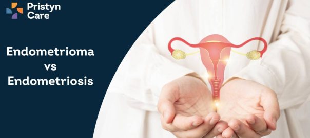 Endometrioma vs Endometriosis