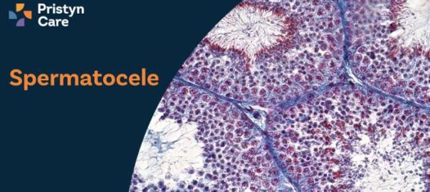 Spermatocele: Causes, Symptoms & Treatment Options