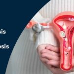 Adenomyosis Vs Endometriosis
