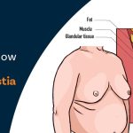 How Do I Know If I Have Gynecomastia?