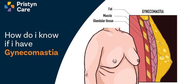 How Do I Know If I Have Gynecomastia?