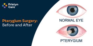 Pterygium Surgery: Before and After