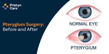 Pterygium Surgery: Before and After