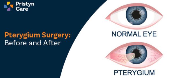 Pterygium Surgery: Before and After