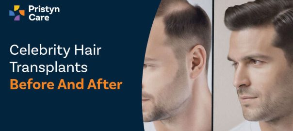 Celebrity Hair Transplants Before And After