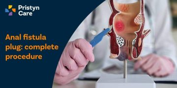 Anal Fistula Plug
