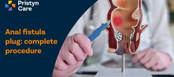Anal Fistula Plug: Complete Procedure