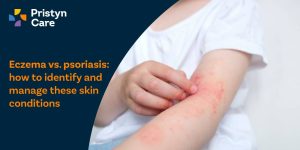 Eczema vs. psoriasis
