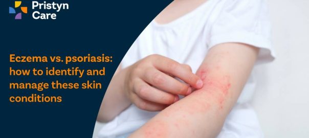 Eczema Vs Psoriasis: How to Identify and Manage These Skin Conditions?