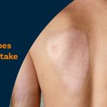 How long does a skin graft take to heal​