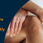 How to cure psoriasis permanently