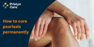 How to cure psoriasis permanently