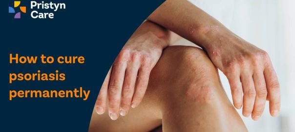 How To Cure Psoriasis Permanently?