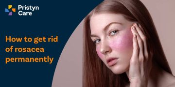 How to get rid of rosacea permanently​