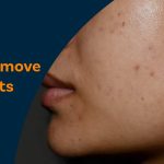 How to remove black spots on face