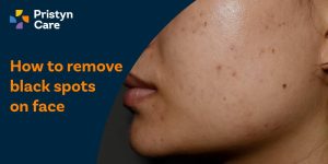 How to remove black spots on face