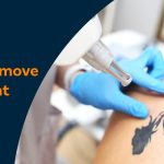 How to remove permanent tattoo​