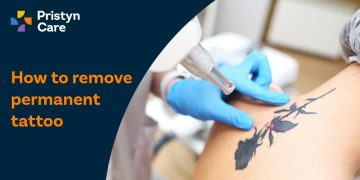 How to remove permanent tattoo​