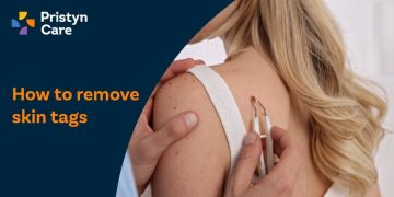 How to remove skin tags