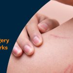 How to remove surgery stitches marks and keloid scars