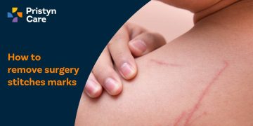 How to remove surgery stitches marks and keloid scars