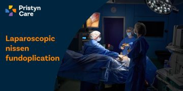 Laparoscopic Nissen Fundoplication