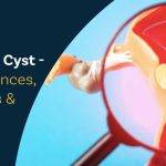 fibroid vs cysts