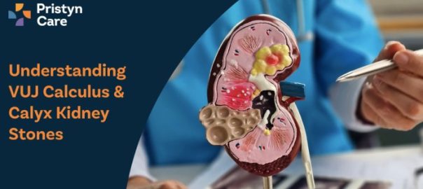 Understanding VUJ Calculus & Calyx Kidney Stones