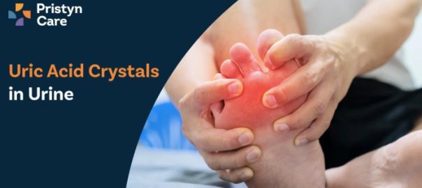 Uric Acid Crystals in Urine – Causes, Symptoms & Treatment