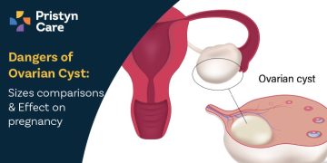 Dangers of Ovarian Cyst- Sizes comparisons