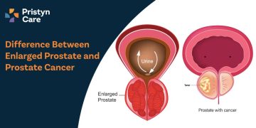 Difference-Between--Enlarged-Prostate-and--Prostate-Cancer.