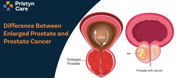 Difference Between Enlarged Prostate and Prostate Cancer