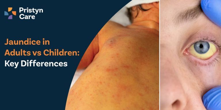 Jaundice-in-Adults-vs-Children-Key-Differences