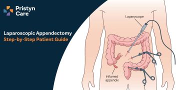 Laparoscopic-Appendectomy-Step-by-Step-Patient-Guide