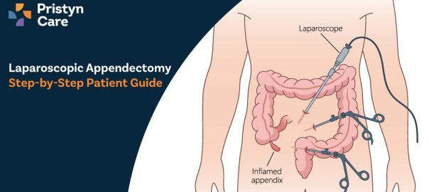 Laparoscopic Appendectomy – Step-by-Step Patient Guide