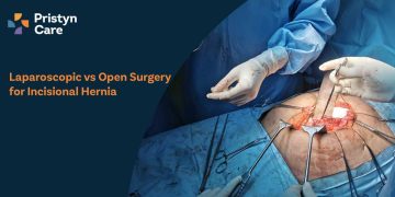 Laparoscopic vs Open Surgery for Incisional Hernia