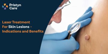 Laser Treatment for Skin Lesions – Indications and Benefits