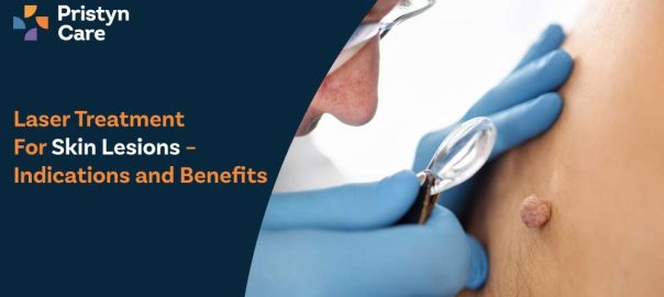 Laser Treatment for Skin Lesions – Indications and Benefits