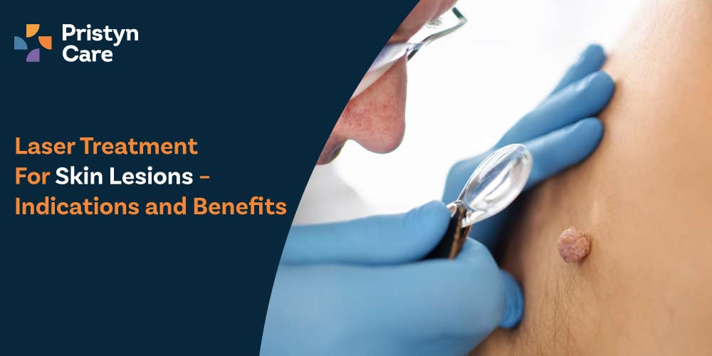 Laser Treatment for Skin Lesions – Indications and Benefits