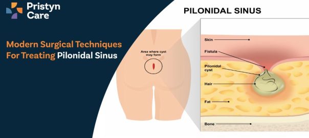 Modern Surgical Techniques for Treating Pilonidal Sinus