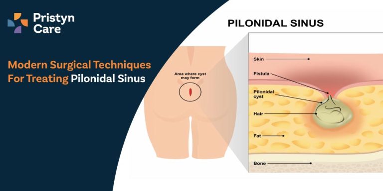 Modern-Surgical-Techniques--For-Treating-Pilonidal-Sinus