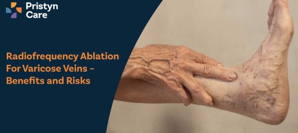 Radiofrequency Ablation for Varicose Veins – Benefits and Risks