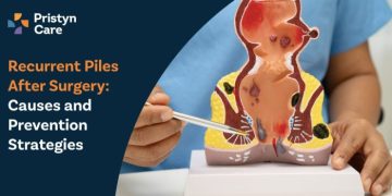 Recurrent-Piles-After-Surgery-–-Causes-and-Prevention-Strategies