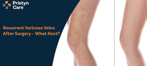Recurrent Varicose Veins After Surgery – What Next?
