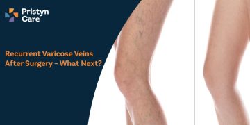 Recurrent Varicose Veins After Surgery – What Next?