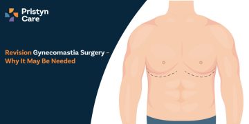 Revision Gynecomastia Surgery – Why It May Be Needed
