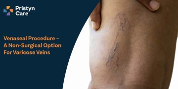 Venaseal Procedure – A Non-Surgical Option for Varicose Veins